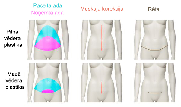 Vēdera plastika