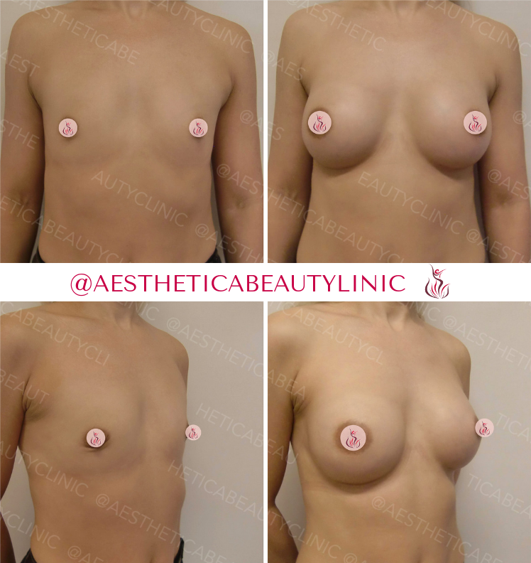 Breast augmentation