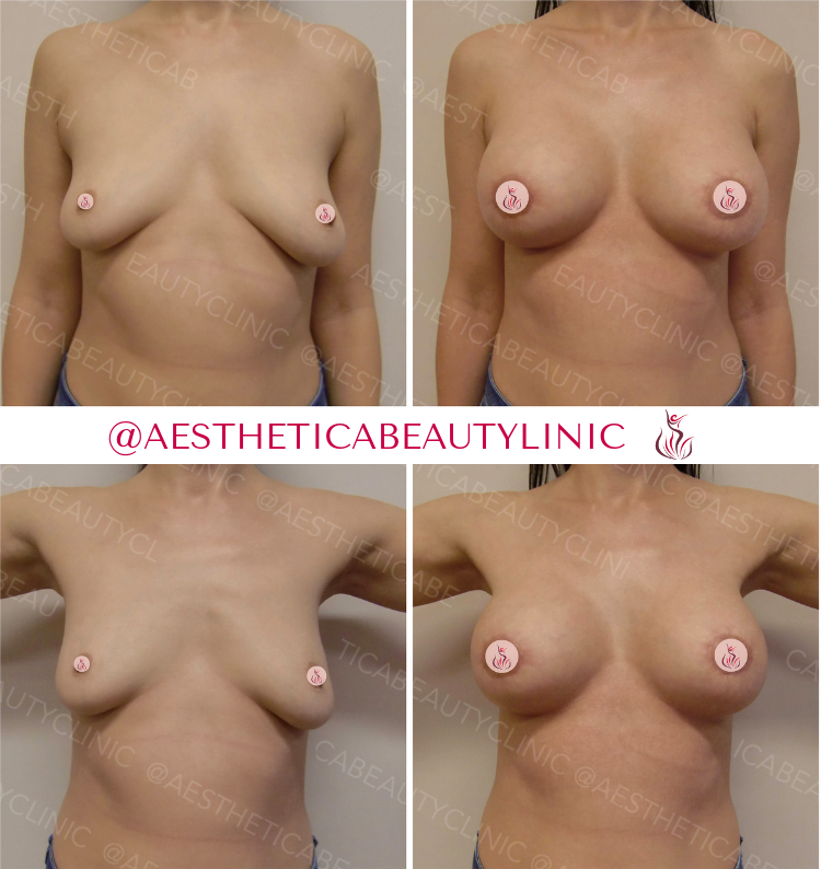 Breast augmentation