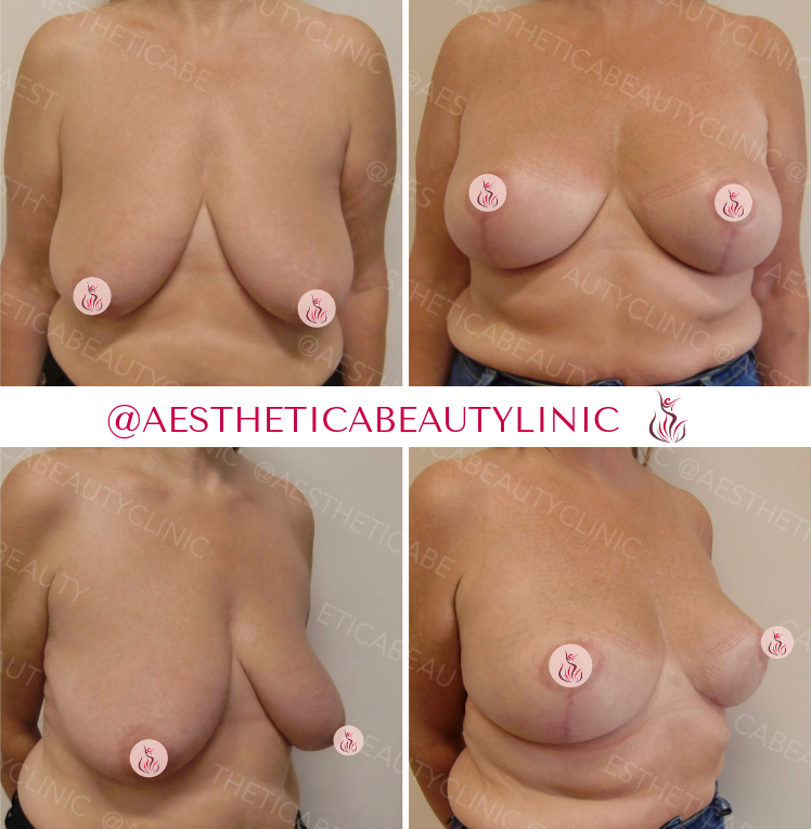 Breast lift without implants