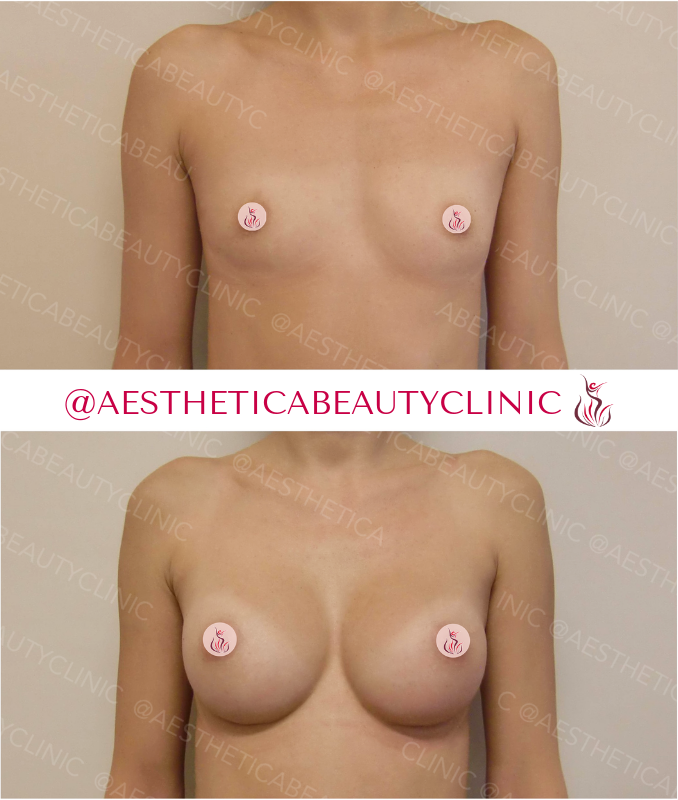 Breast augmentation