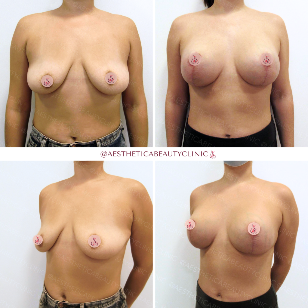 before and after image that shows breast lift with implants