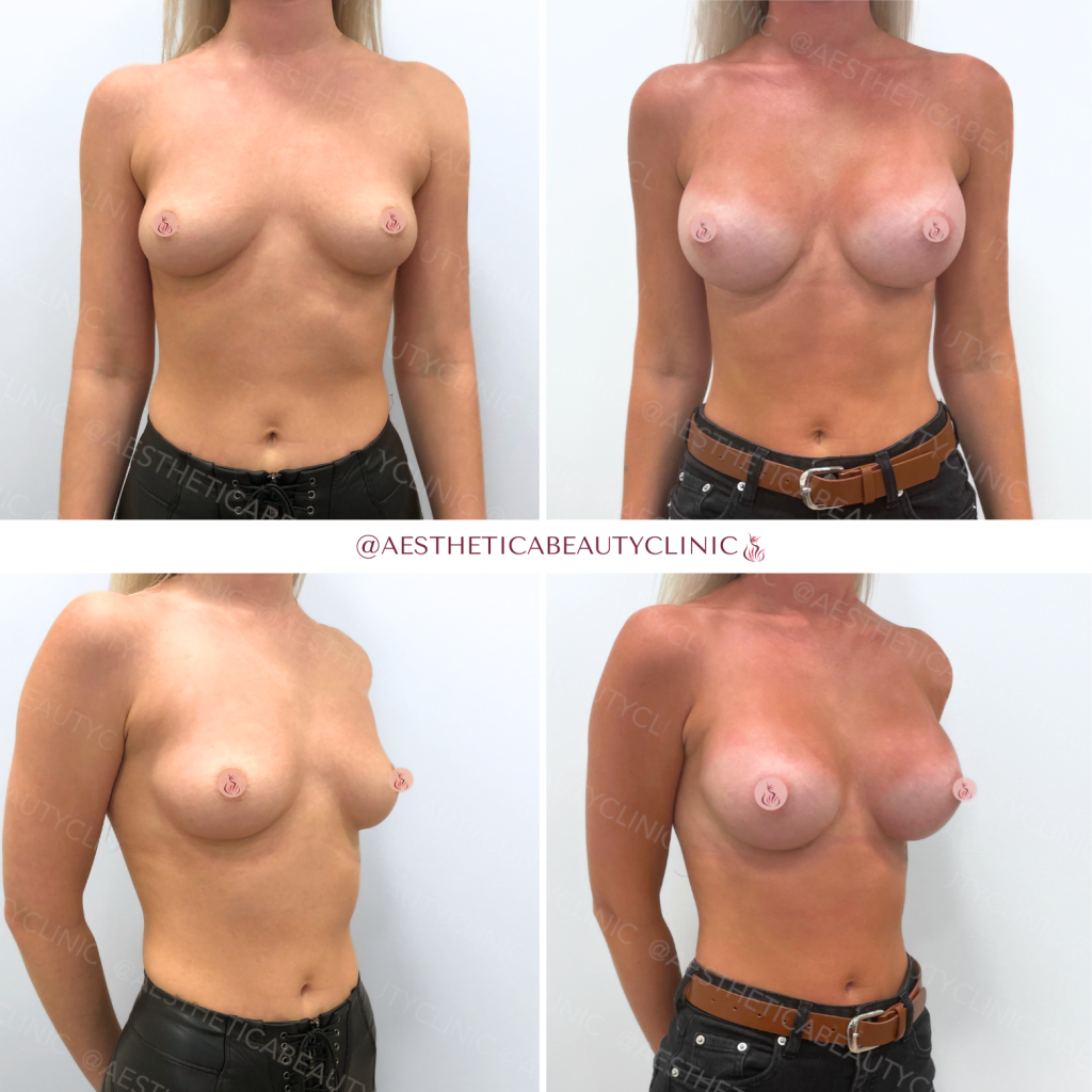 Breast augmentation by Dr. Ieva Lace