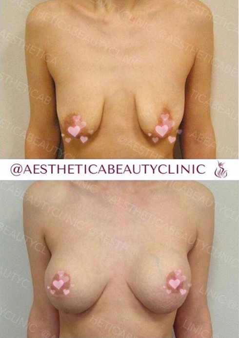 Breast augmentation
