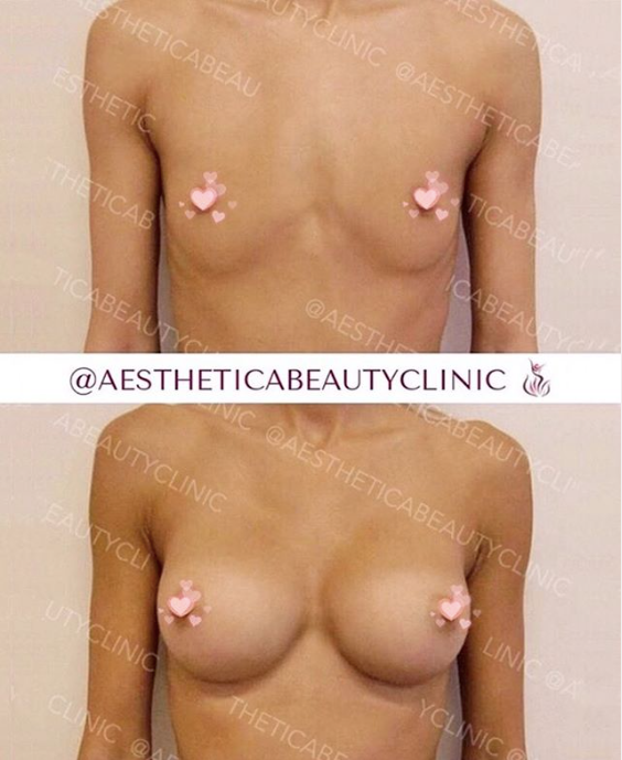 Breast augmentation