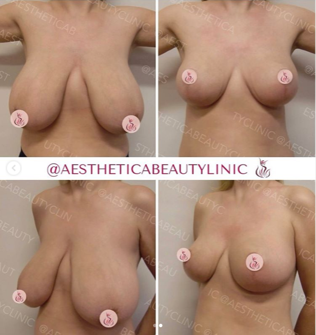 Breast reduction
