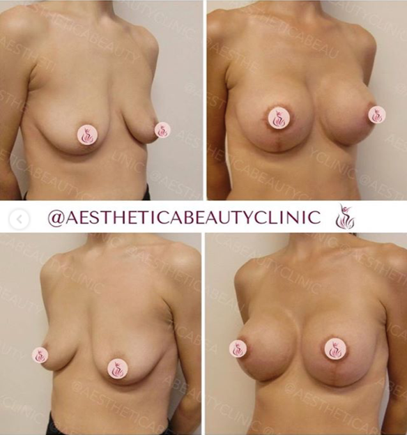 Breast lift