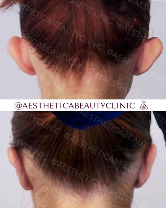 Ear correction