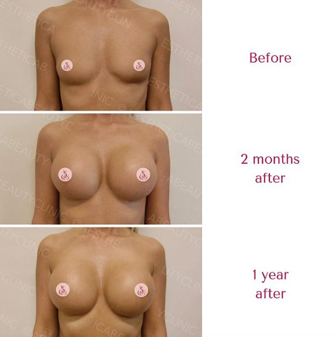 Breast augmentation