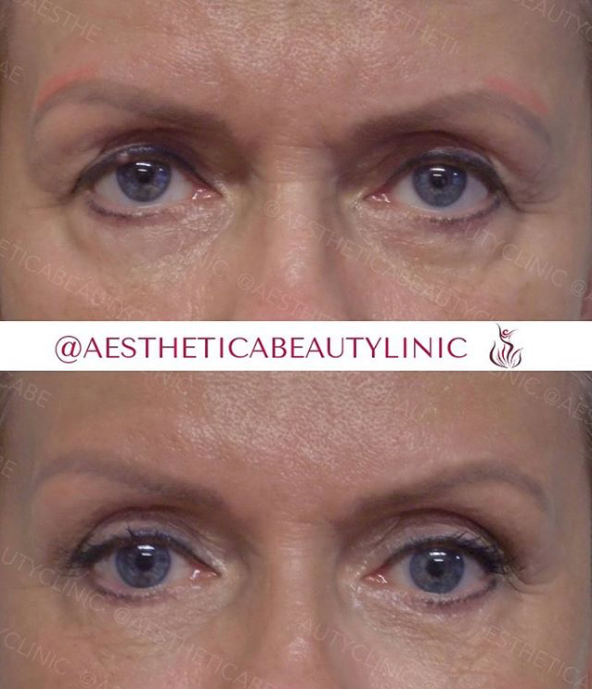 Eyebrow lift
