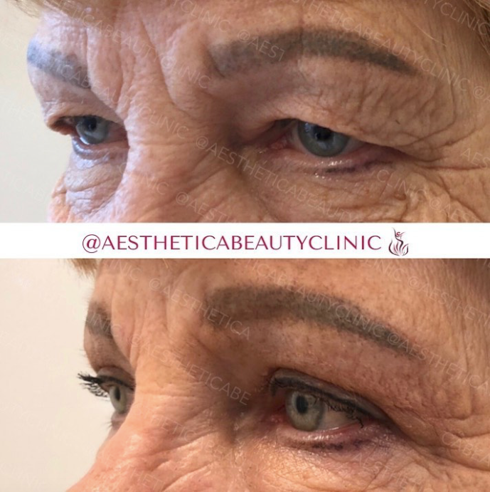 Blepharoplasty