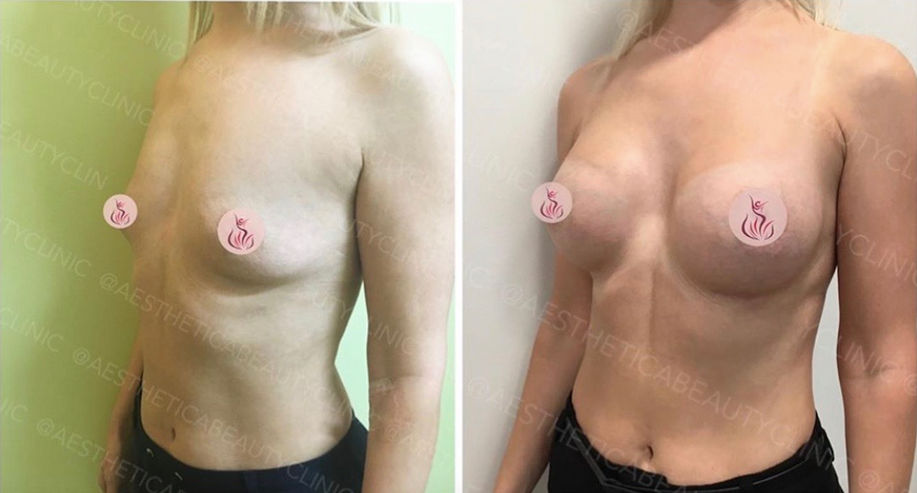 Breast augmentation